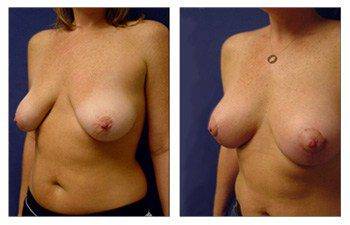 Breast Asymmetry in Size and Shape