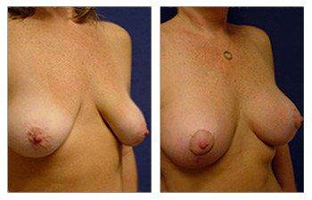 Breast Lift With Implant Augmentation