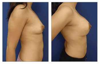 right view Breast Lift With Implant Augmentation Southern California