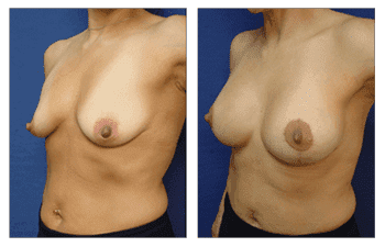 Breast Lift With Implant Augmentation