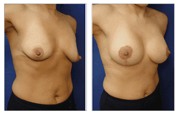 Lift With Implant Augmentation Patient 27 year