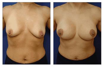 Breast Lift With Implant Augmentation