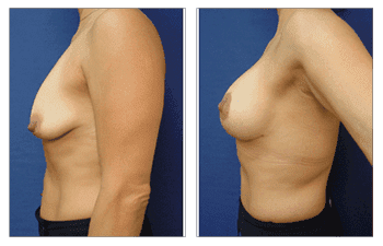 Breast Lift With implants in Los Angeles