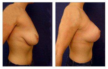 Breast lift implant