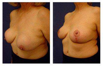 left front oblique Breast Lift With Implant Augmentation To Correct Capsular Contracture