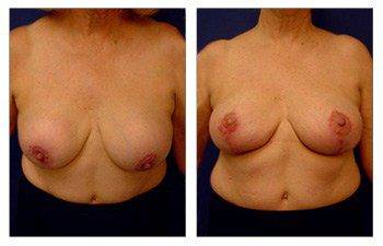 front view Breast Lift With Implant Augmentation To Correct Capsular Contracture