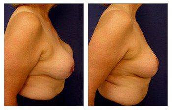 Breast Lift With Implant Augmentation To Correct Capsular Contracture