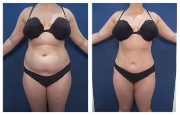 A woman in a bikini before and after liposuction, with the transformation showcasing the remarkable results of her toned physique.