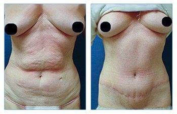 Eliminating Upper Belly Stretch Marks With Tummy Tuck