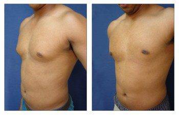 Gynecomastia