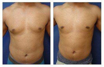 Gynecomastia