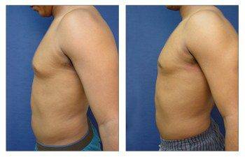 Gynecomastia