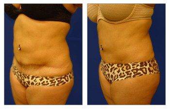 Amazing Results of Mini Tummy Scars