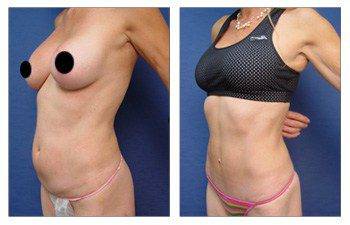 MIni Tummy Tuck