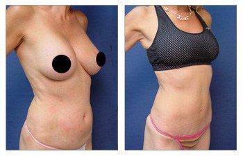 MIni Tummy Tuck