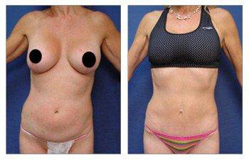 MIni Tummy Tuck