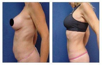 Is Mini Tummy Tuck Better for a Fit Girl