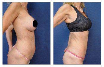 MIni Tummy Tuck