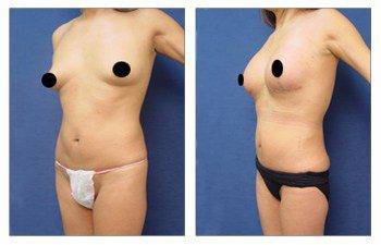 MIni Tummy Tuck