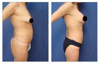 MIni Tummy Tuck