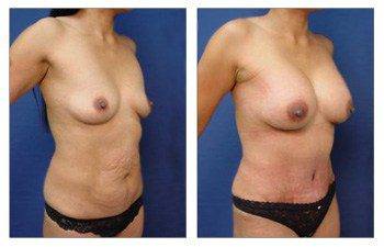 Mommy Makeover To Eliminate Stretch Marks