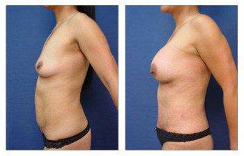 Mommy Makeover To Eliminate Stretch Marks