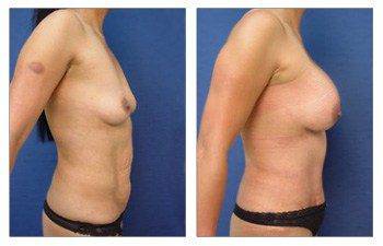 Mommy Makeover To Eliminate Stretch Marks