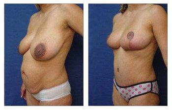 Mommy Makeover With Mini Tummy Tuck And Breast Lift left oblique view