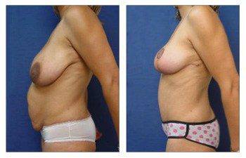 Mommy Makeover With Mini Tummy Tuck And Breast Lift left view