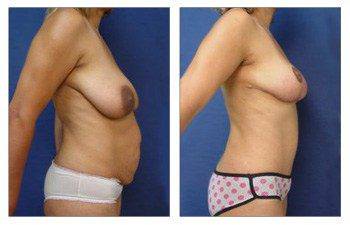 Mommy makeover and breast lift