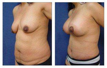 Mommy Makeover With Tummy Tuck And Breast Lift With Implant Augmentation