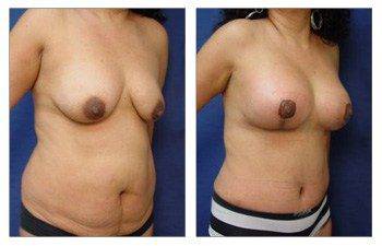 Mommy Makeover With Tummy Tuck And Breast Lift With Implant Augmentation