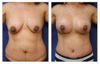 Mommy Makeover With Tummy Tuck And Breast Lift With Implant Augmentation