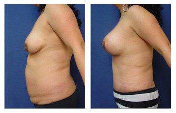 Mommy Makeover With Tummy Tuck And Breast Lift With Implant Augmentation