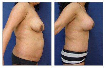 Mommy Makeover With Tummy Tuck And Breast Lift With Implant Augmentation