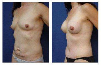 Mommy Makeover With Tummy Tuck And Breast Augmentation