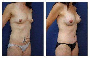 After surgery image of a mommy makeover with a tummy tuck and breast augmentation