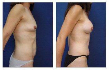 After surgery image of a mommy makeover with a tummy tuck and breast augmentation