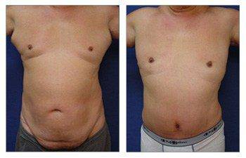 Male Tummy Tuck To Reduce Abdominal Girth