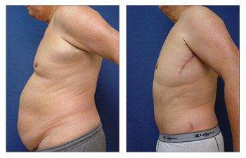 Male Tummy Tuck To Reduce Abdominal Girth