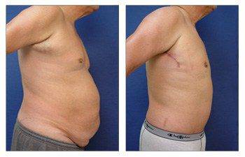 reducing abdominal girth with a tummy tuck Newport Beach