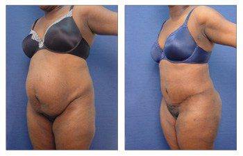 Body contouring of the abdomen and hips. Tummy Tuck and Liposuction - Dr  Girlado