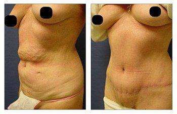 Eliminating Upper Belly Stretch Marks With Tummy Tuck