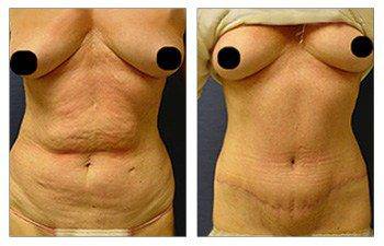 Eliminating Upper Belly Stretch Marks With Tummy Tuck