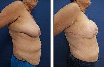 Breast asymmetry Newport Beach