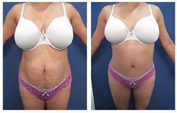 Eliminating Upper Abdominal Skin Rolls with Tummy Tuck