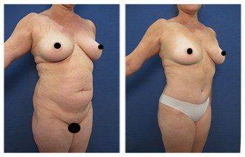 Before and after surgery of VASER Liposuction of Thighs