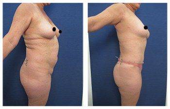 Before and after surgery of VASER Liposuction of Thighs