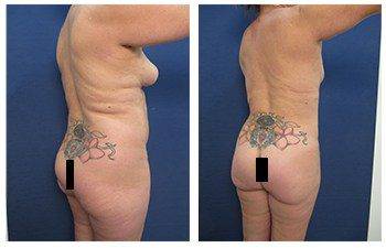 VASER Liposuction of Thighs