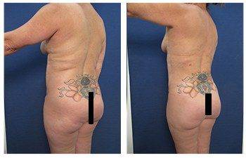 High definition liposuction Laguna Beach